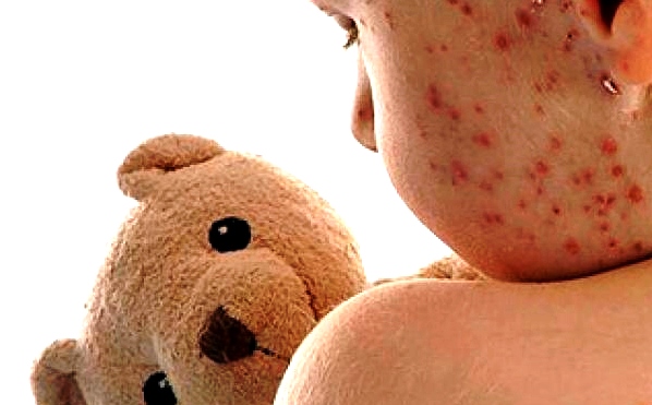 Febre e exantema são sintomas do sarampo (Foto da web: prevenirclinicadevacinas.com.br)
